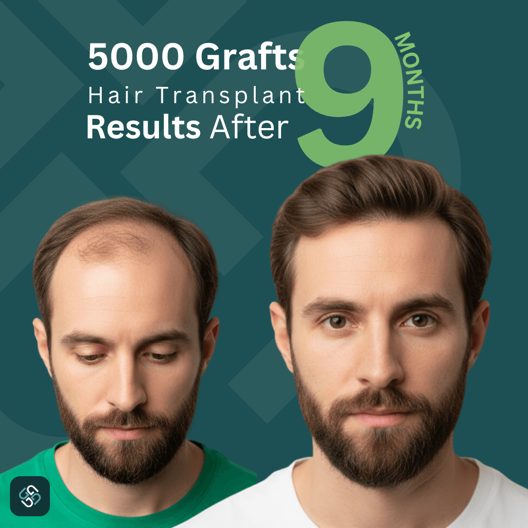 5000 hair transplant Turkey