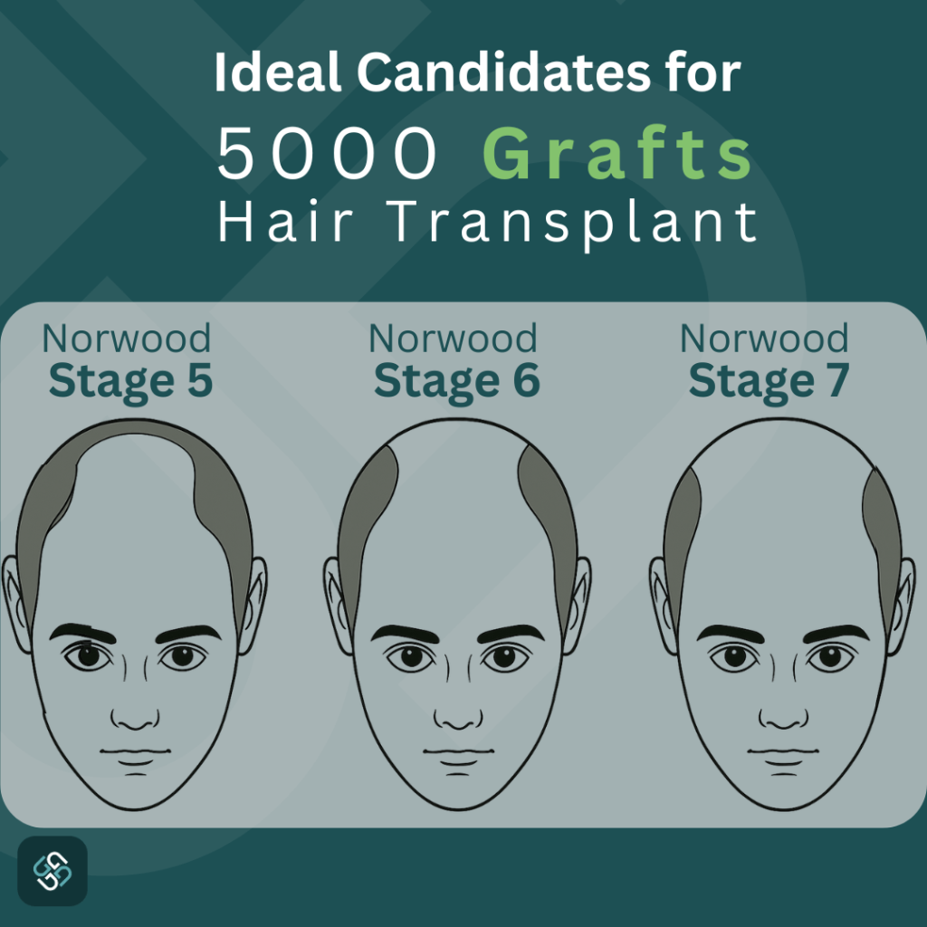 ideal candidate 5000 grafts
