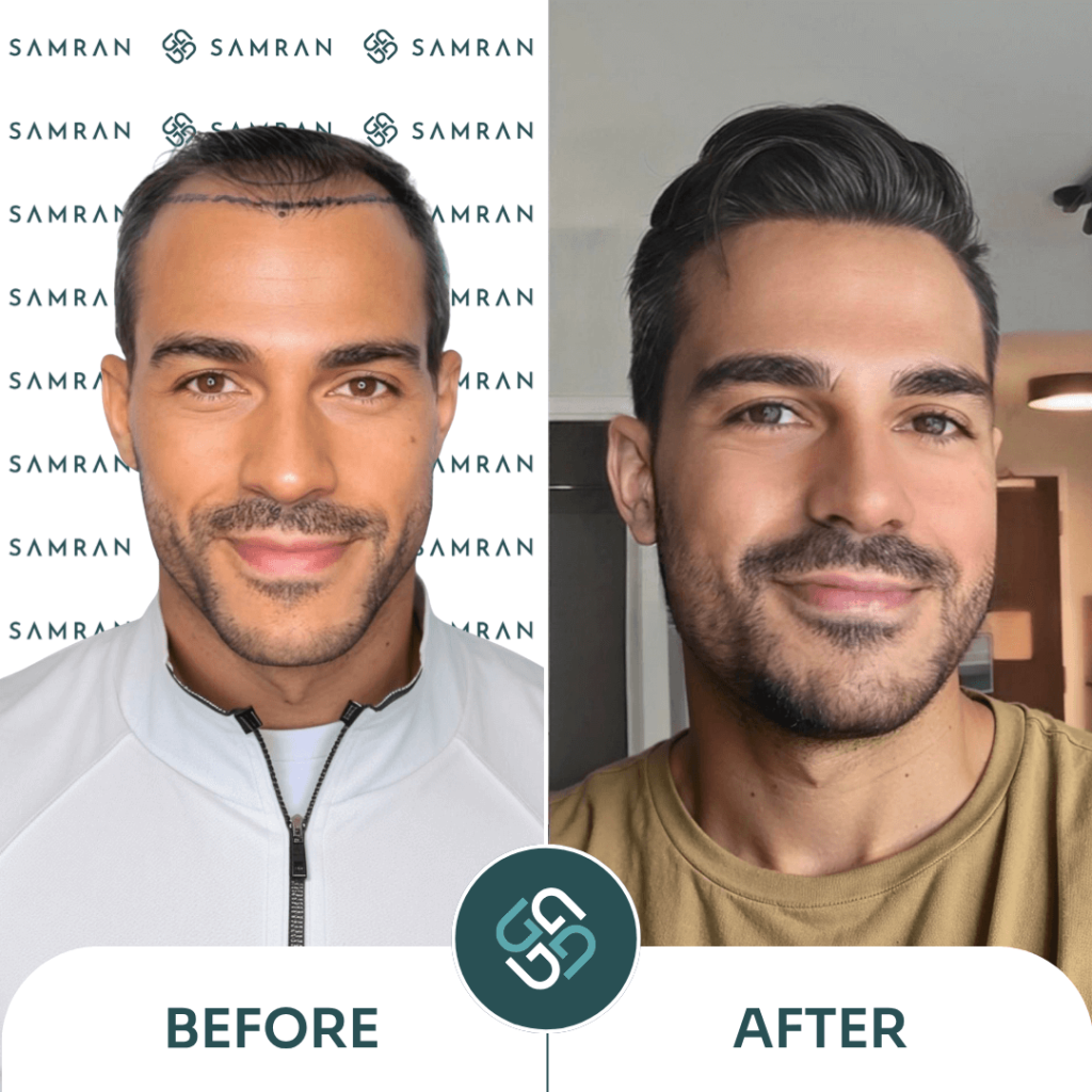Hair Transplant Results DHİ Samran Clinic before and after