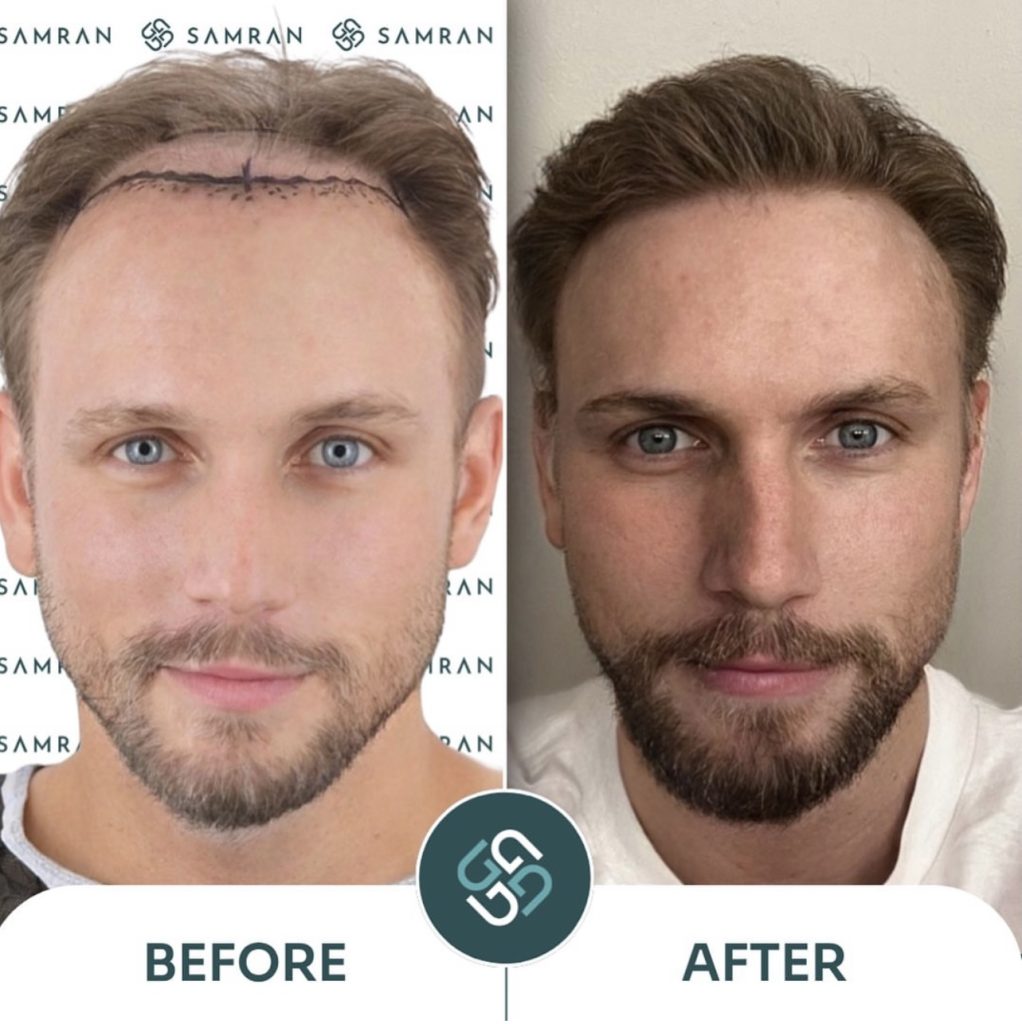 Hair Transplant Results DHİ Samran Clinic before and after