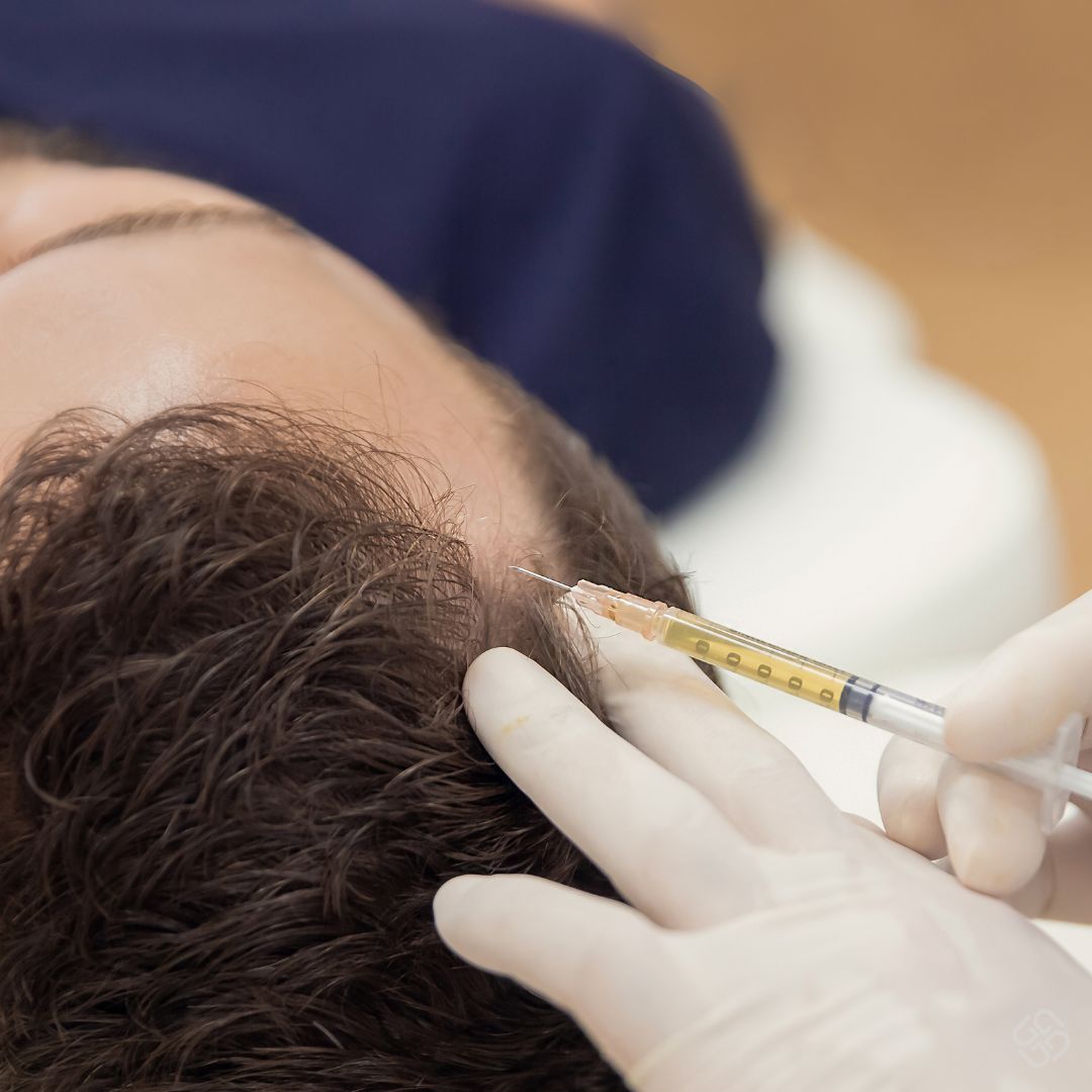 Exosome Hair Transplant