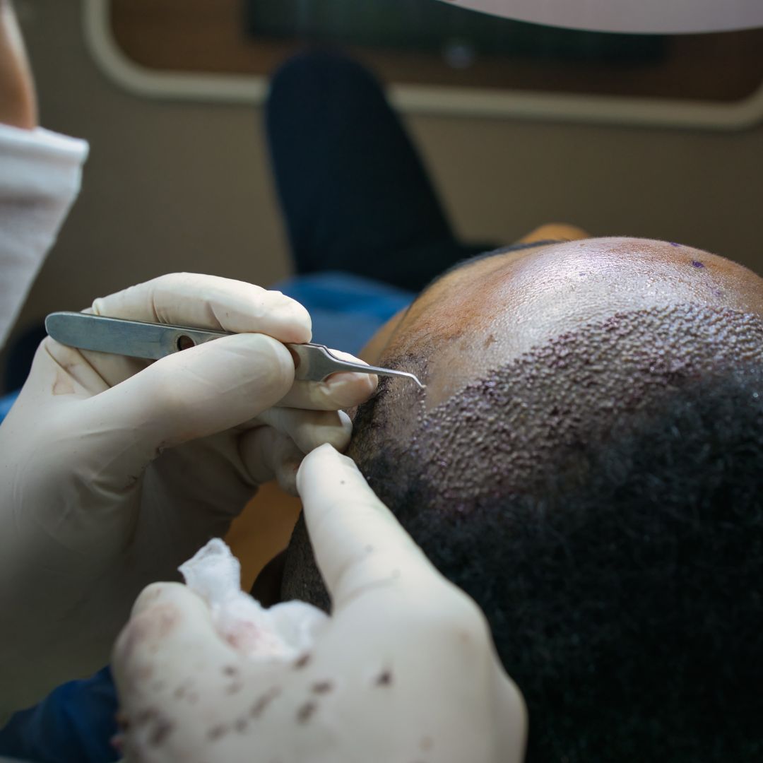 Afro Hair Transplant