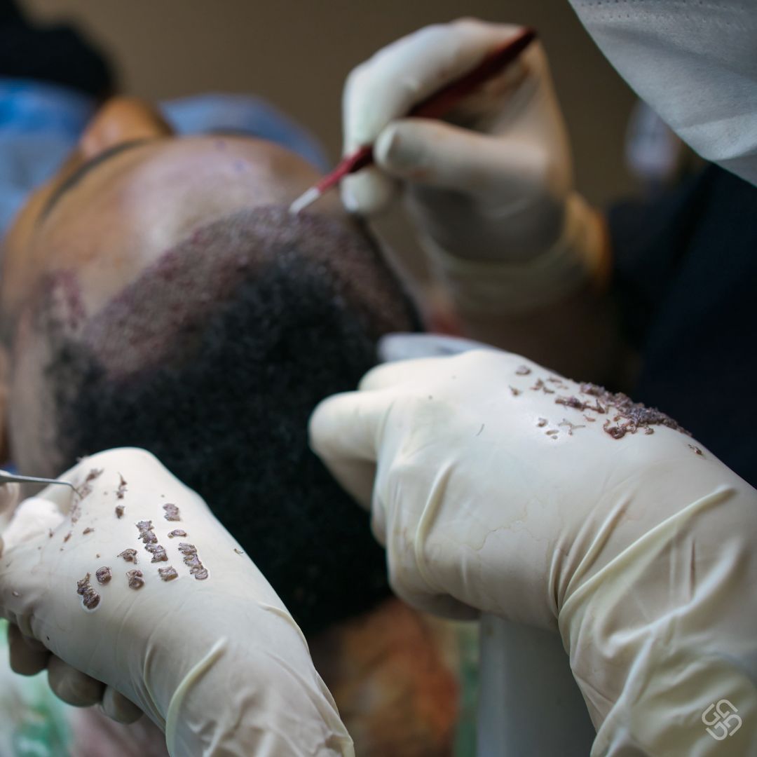 FUE Hair Transplant