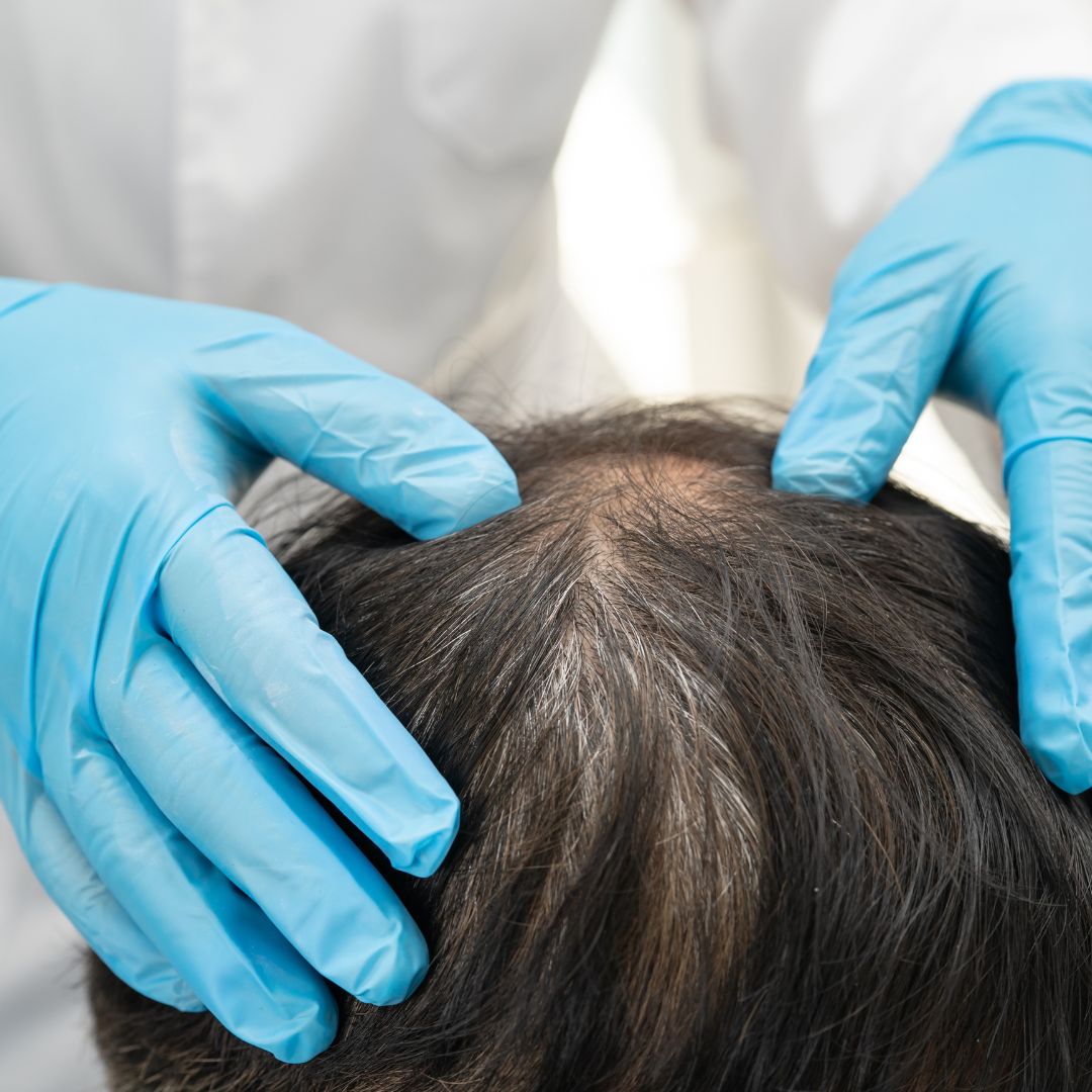 Unshaven Hair Transplant