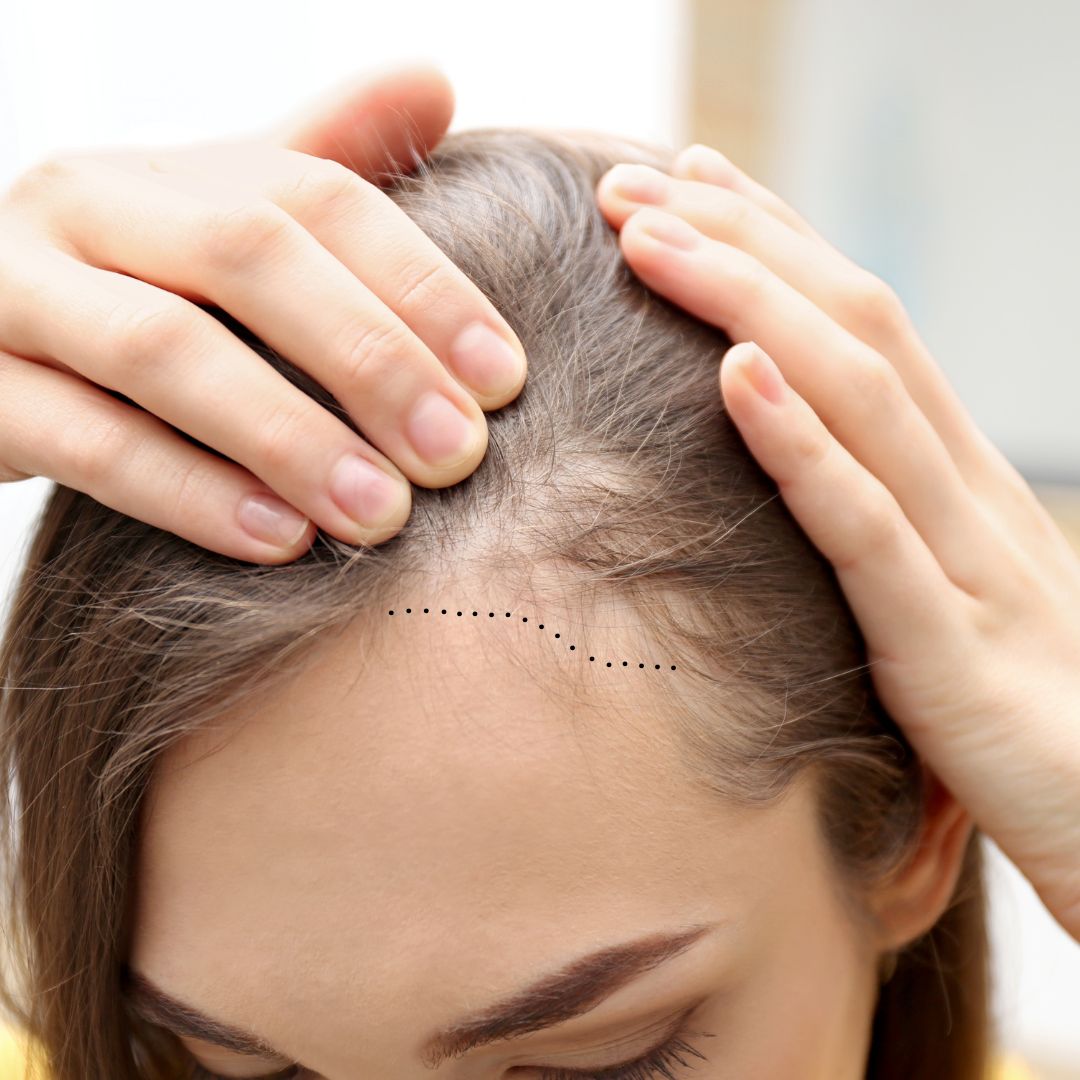 Female Hair Transplant