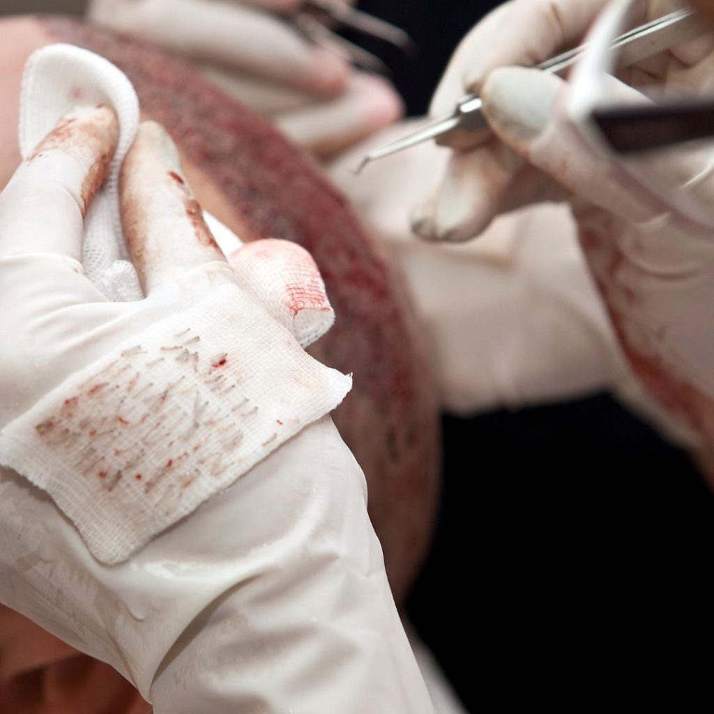 second-hair-transplant-performams