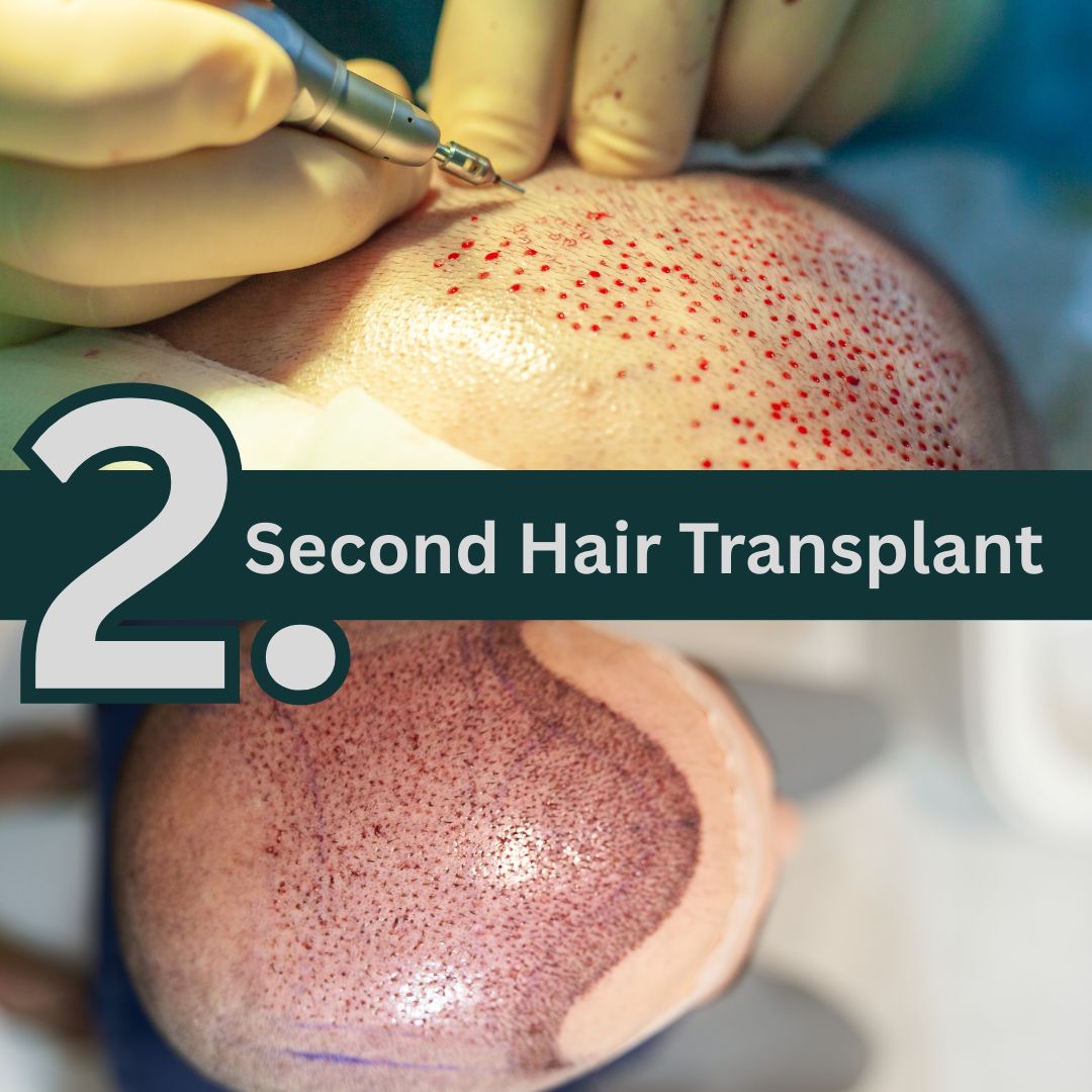 second hair transplant