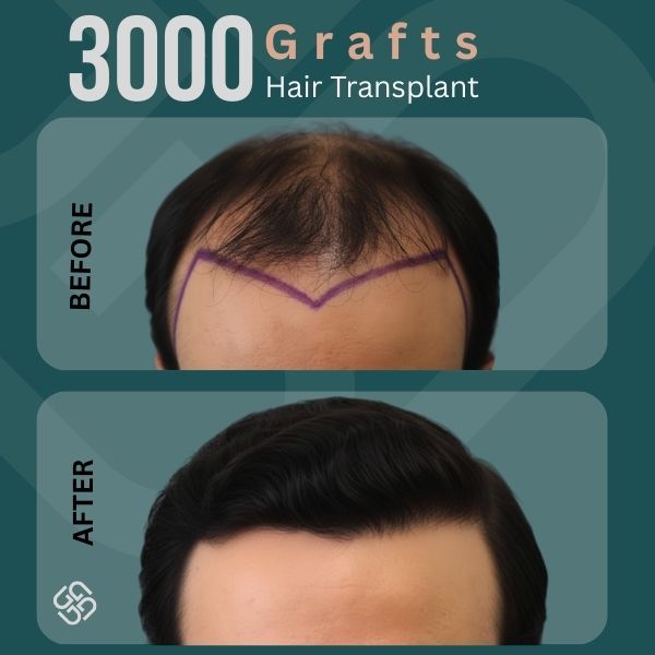 3000 Grafts hair transplant in Turkey