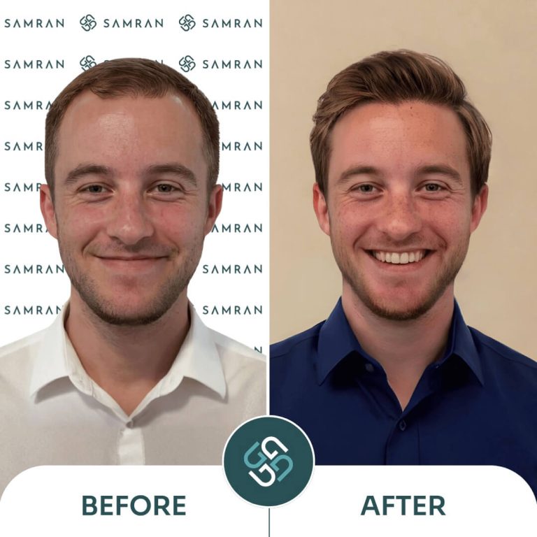 5000 grafts hair transplant before and after