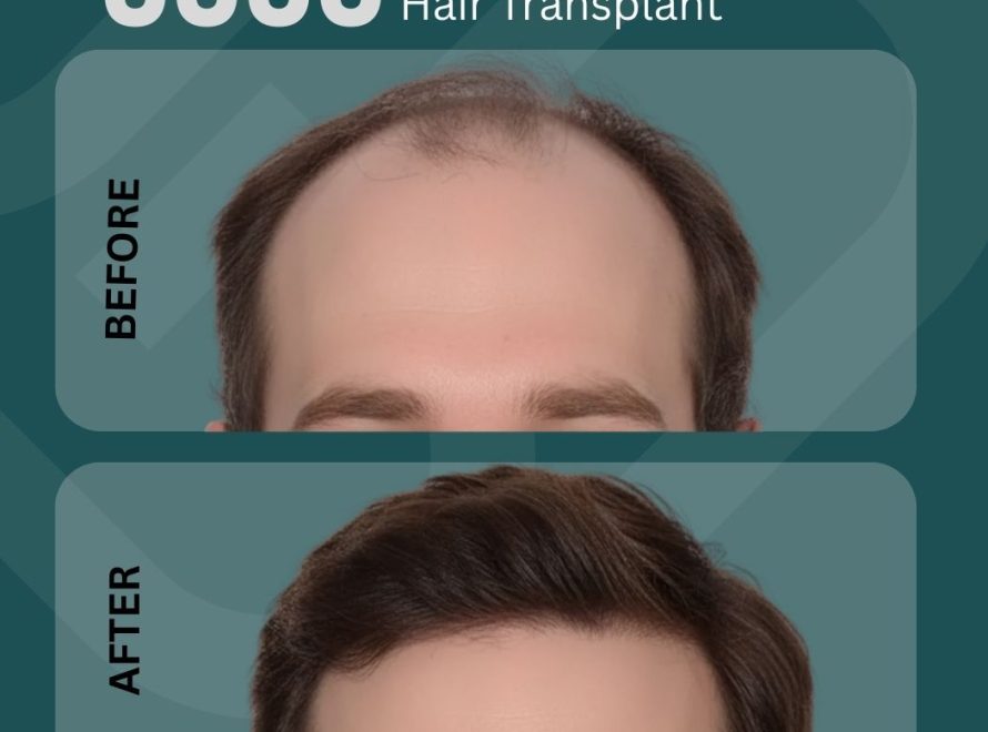 6000 Grafts Hair Transplant Turkey