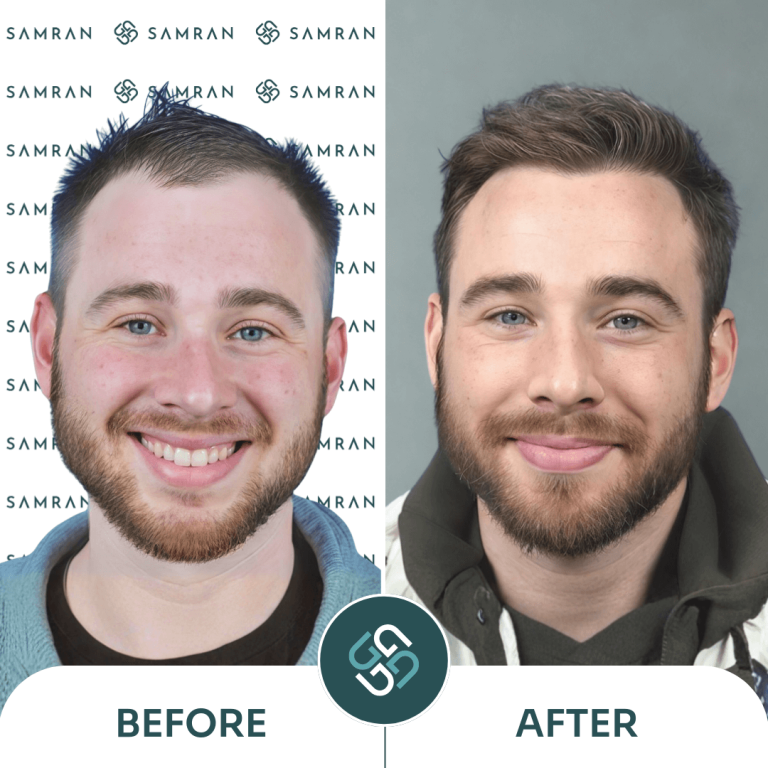 FUE hair transplant before and after