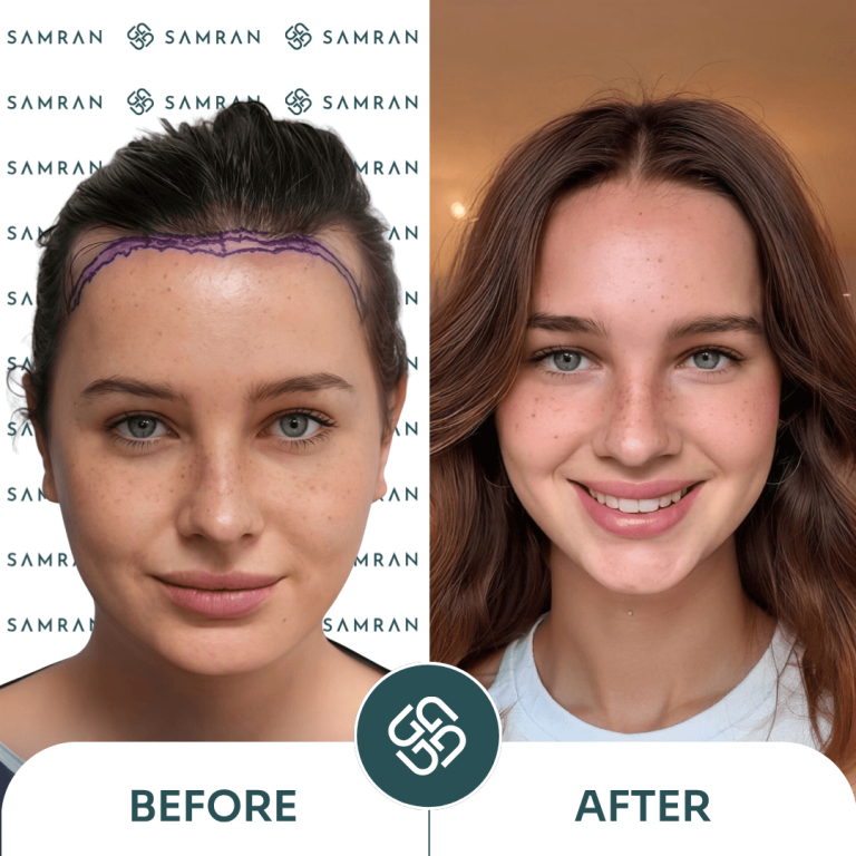 Long hair FUE before and after