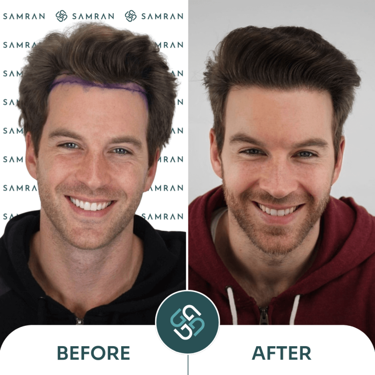 DHI hair transplant before and after