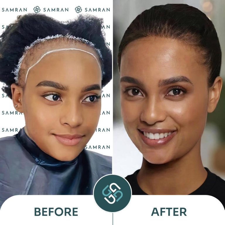 Female hair transplant before and after