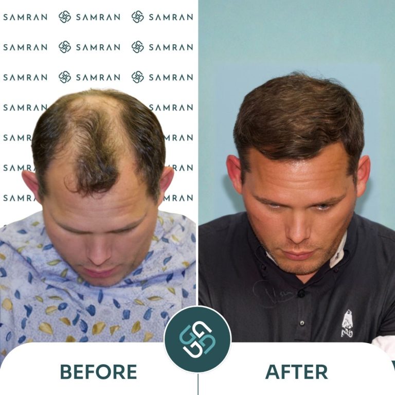 DHI hair transplant before and after