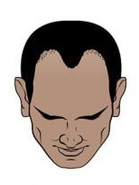 Medium hair loss (Norwood 3)