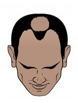 Significant hair loss (Norwood 5)