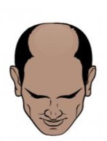 Advanced hair loss (Norwood 6)